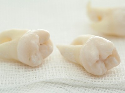 智齒疼了，這牙非拔不可嗎？